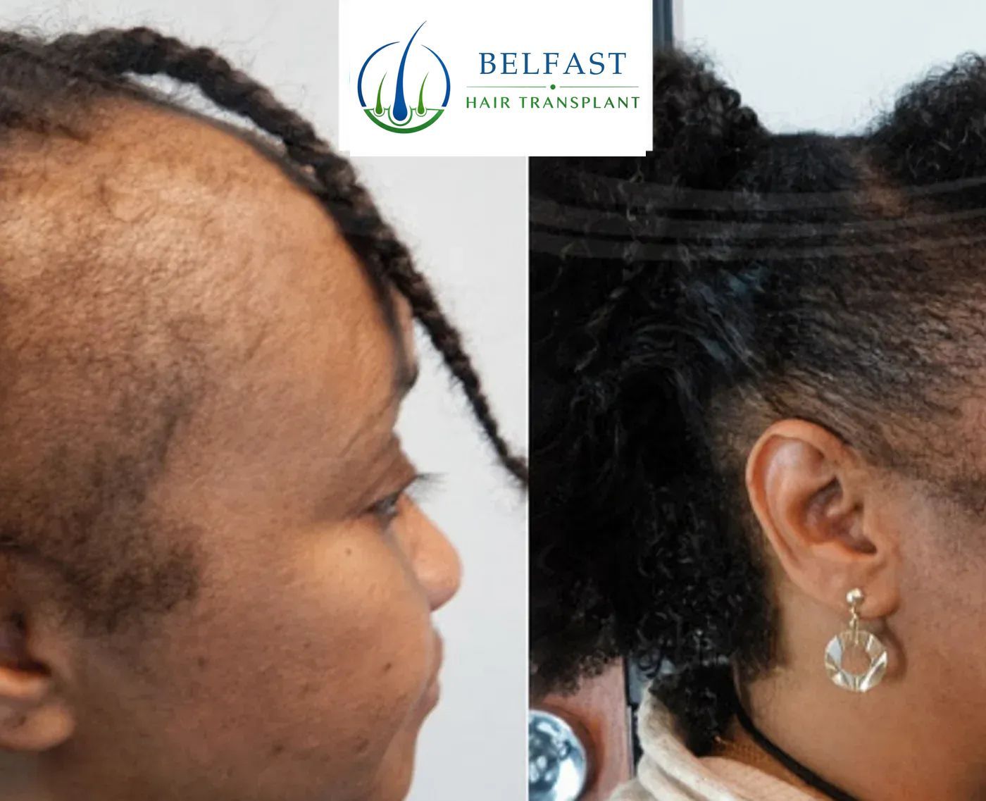 Curly hair transplant before and after result