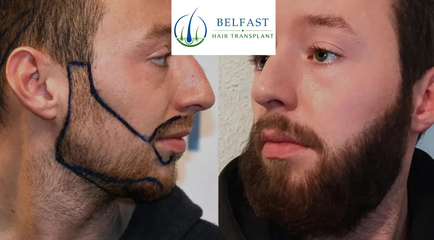 Beard transplant before and after result