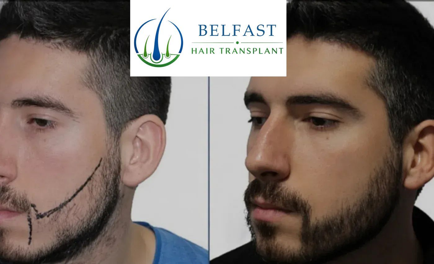 Beard transplant patient result