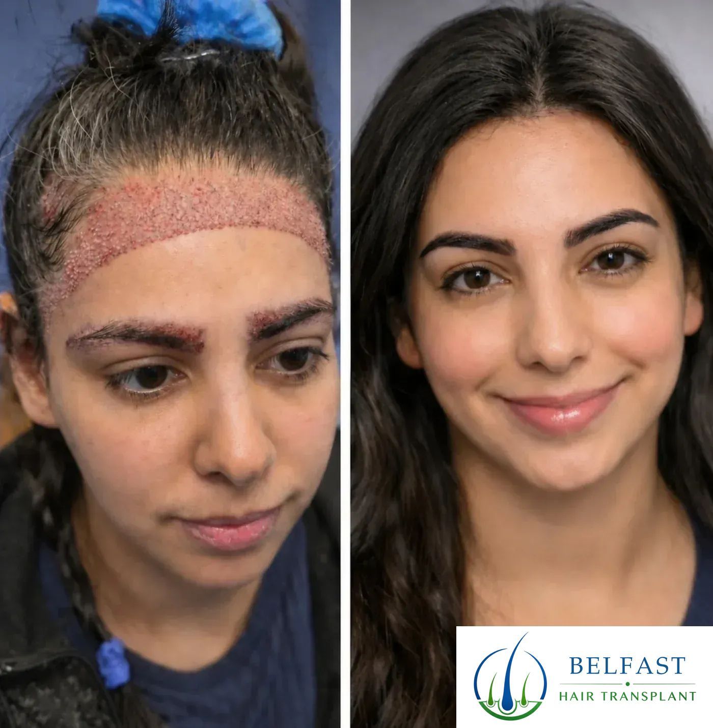 Fatima's hairline and eyebrow transplant result