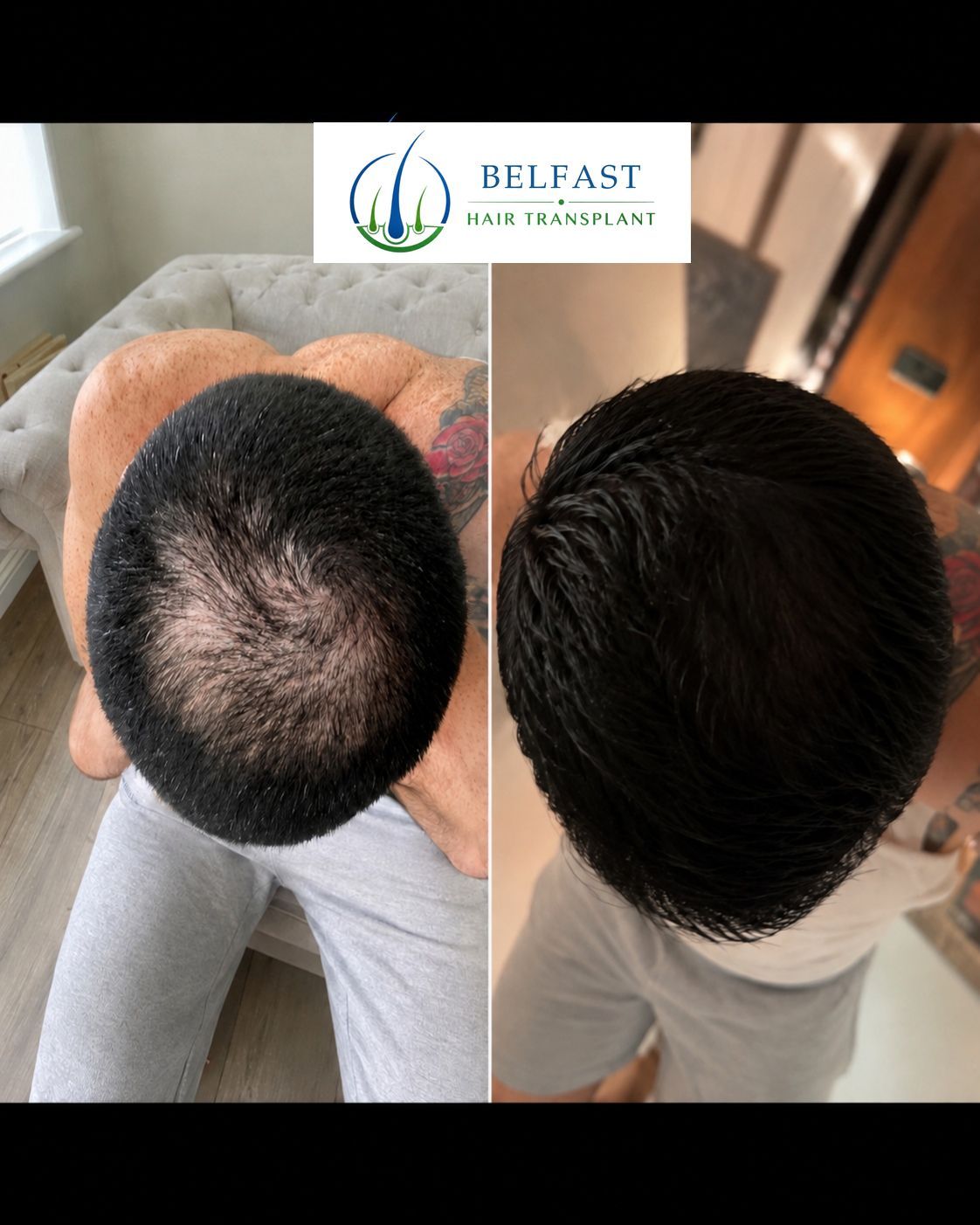 Hair-restoration treatment result