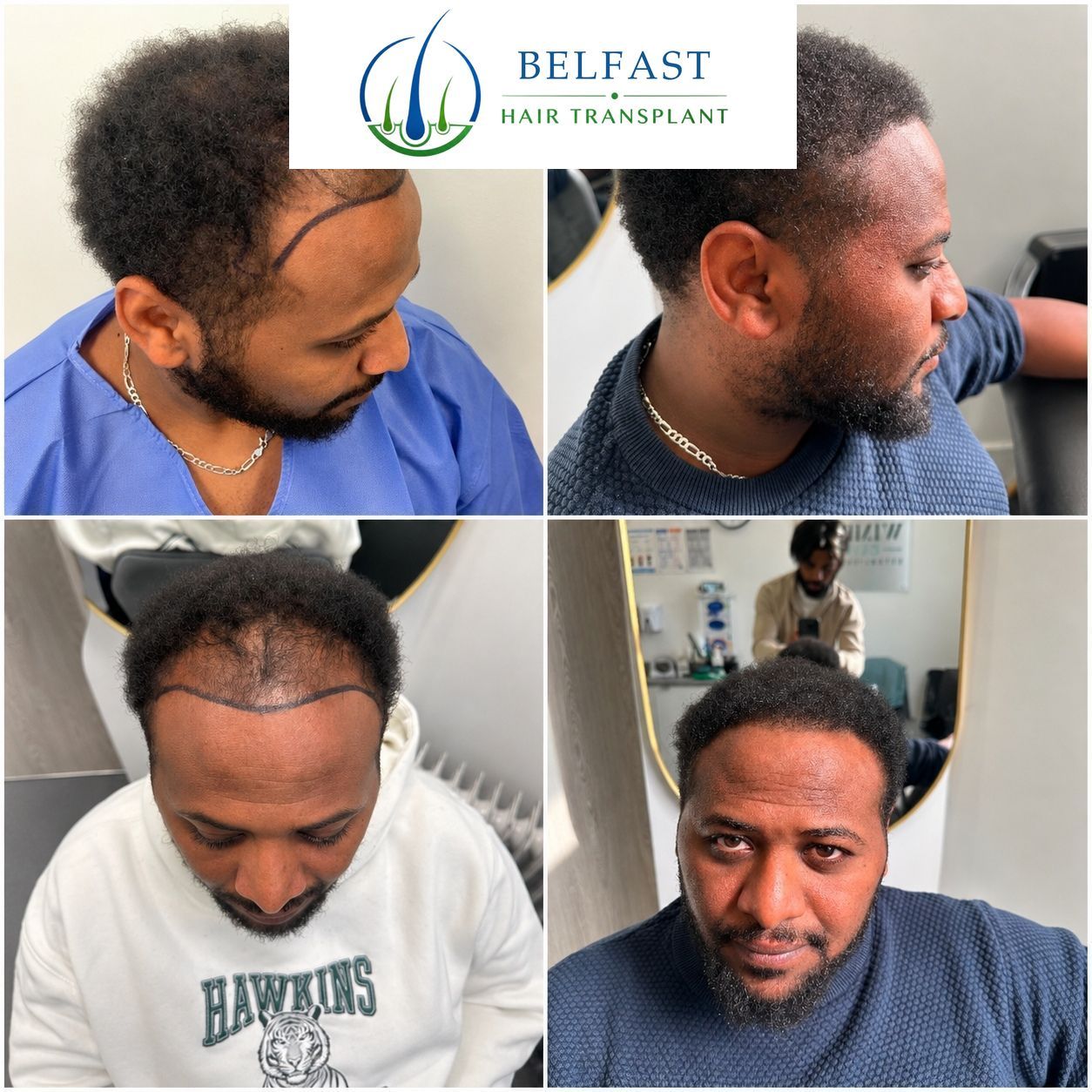 Temple and hairline transplant before and after with 2,000 grafts