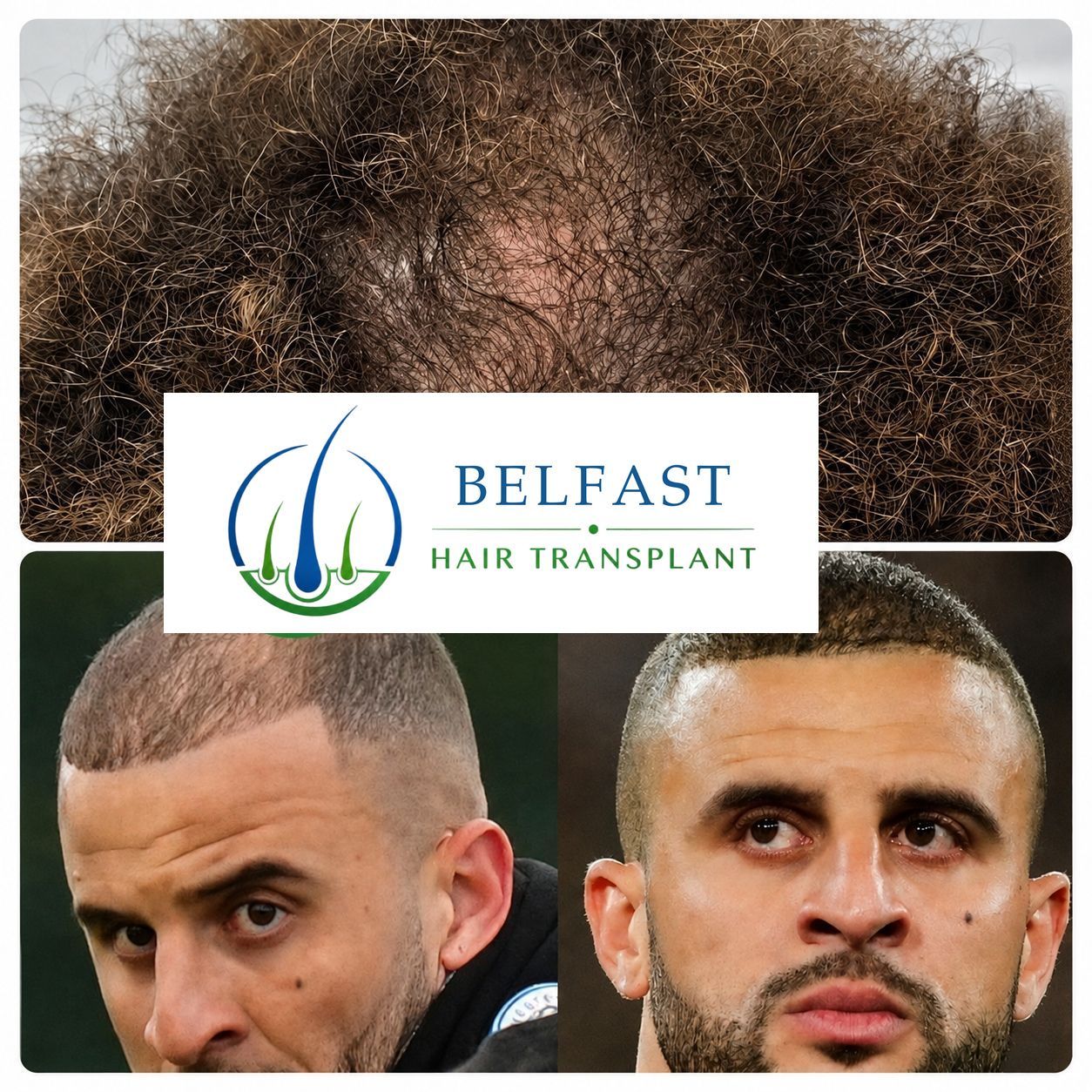Hair transplant patient result Belfast