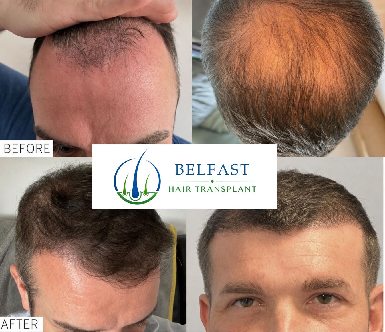 Hair transplant before and after patient result