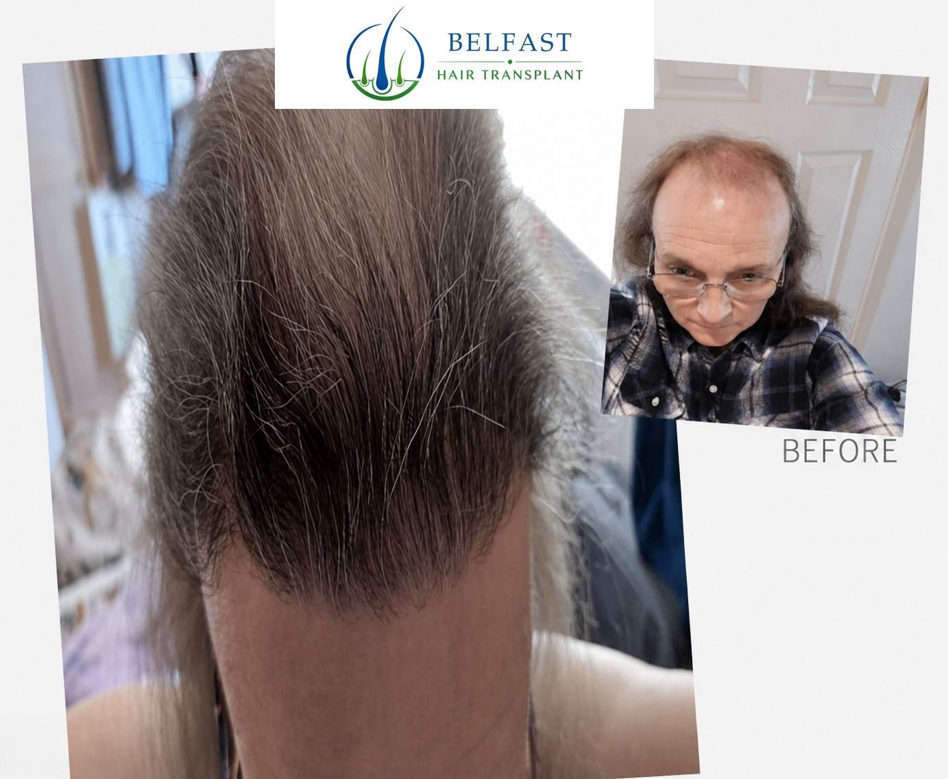 Transgender hair transplant Belfast