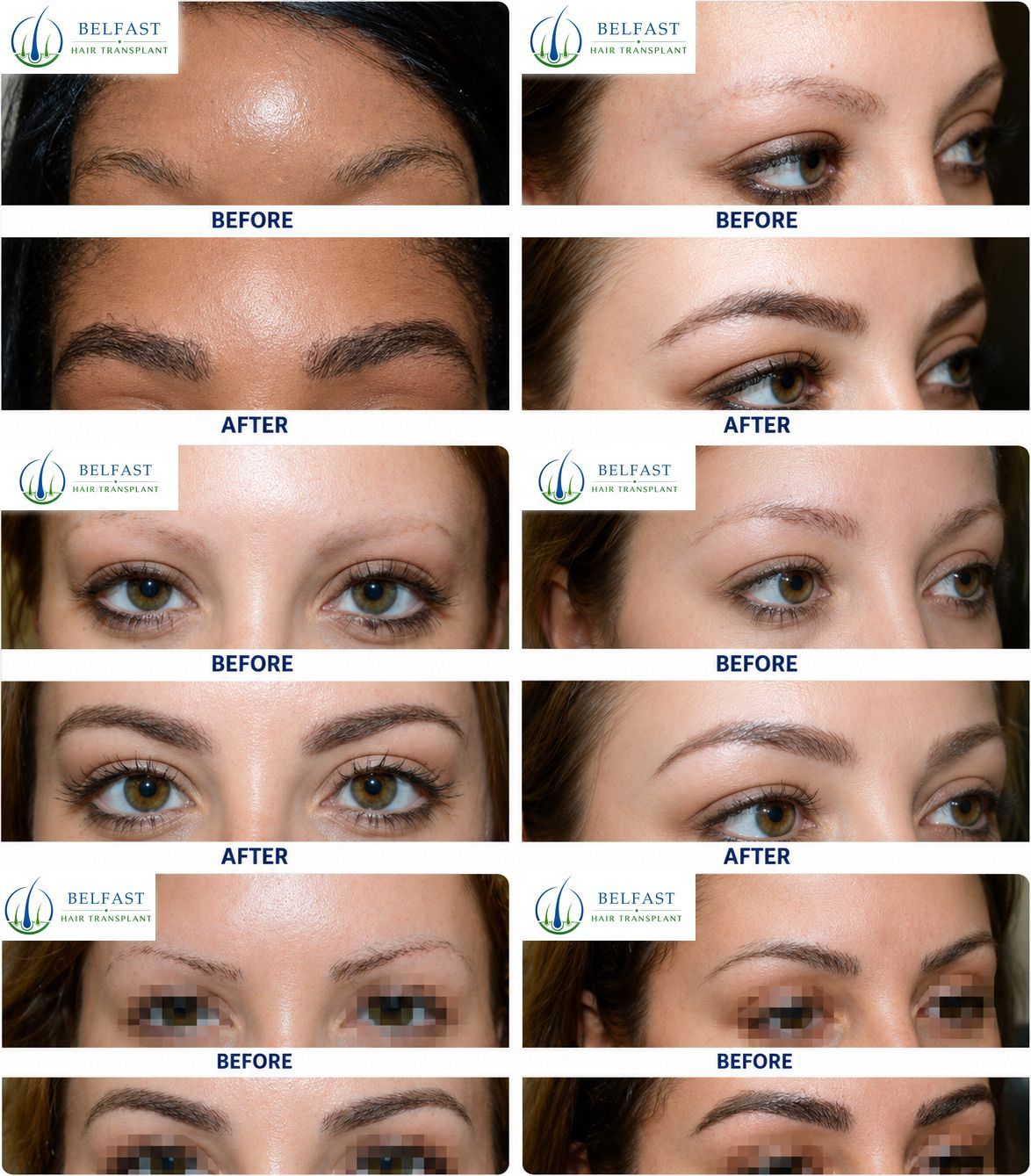 Eyebrow transplant before and after result