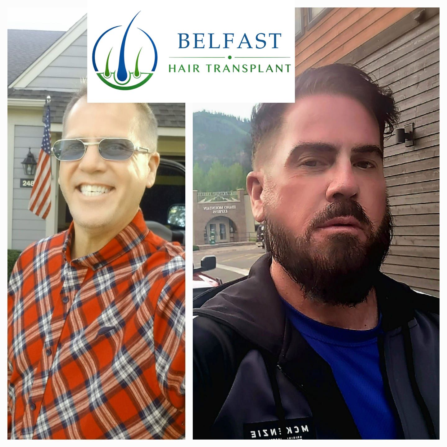 Facial hair transplant result