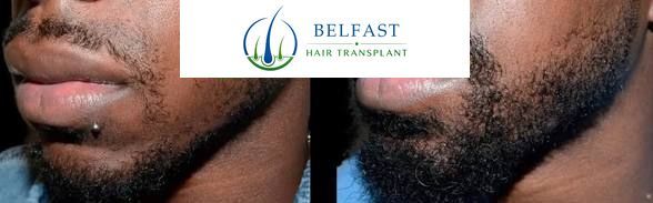 Beard transplant result Belfast