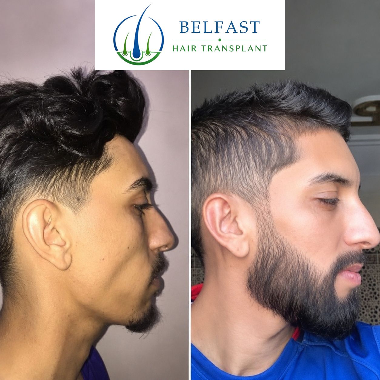 Beard transplant before and after result from Belfast Hair Transplant