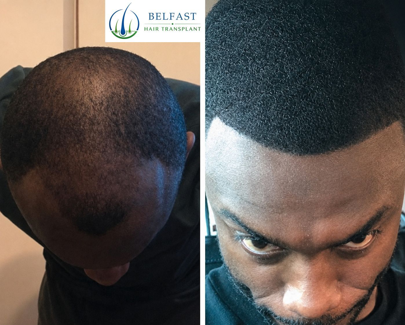Afro-textured frontal hairline transplant result