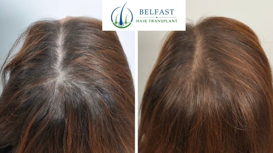 Results after three PRP sessions at four months