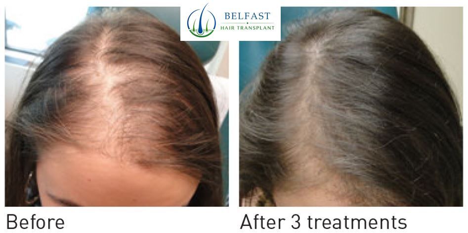 Results after five PRP sessions at six months