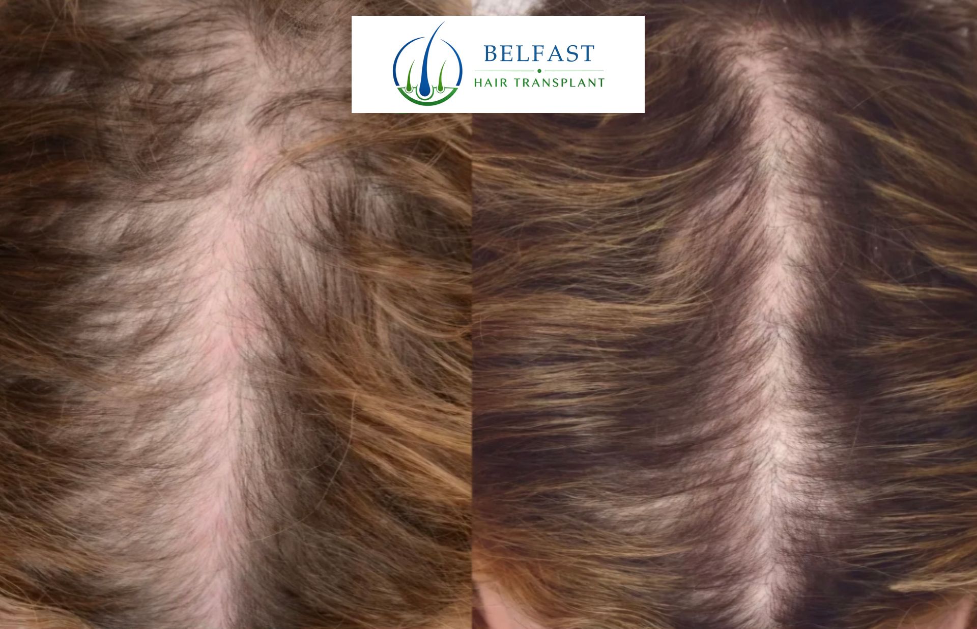 Results after four PRP sessions at five months