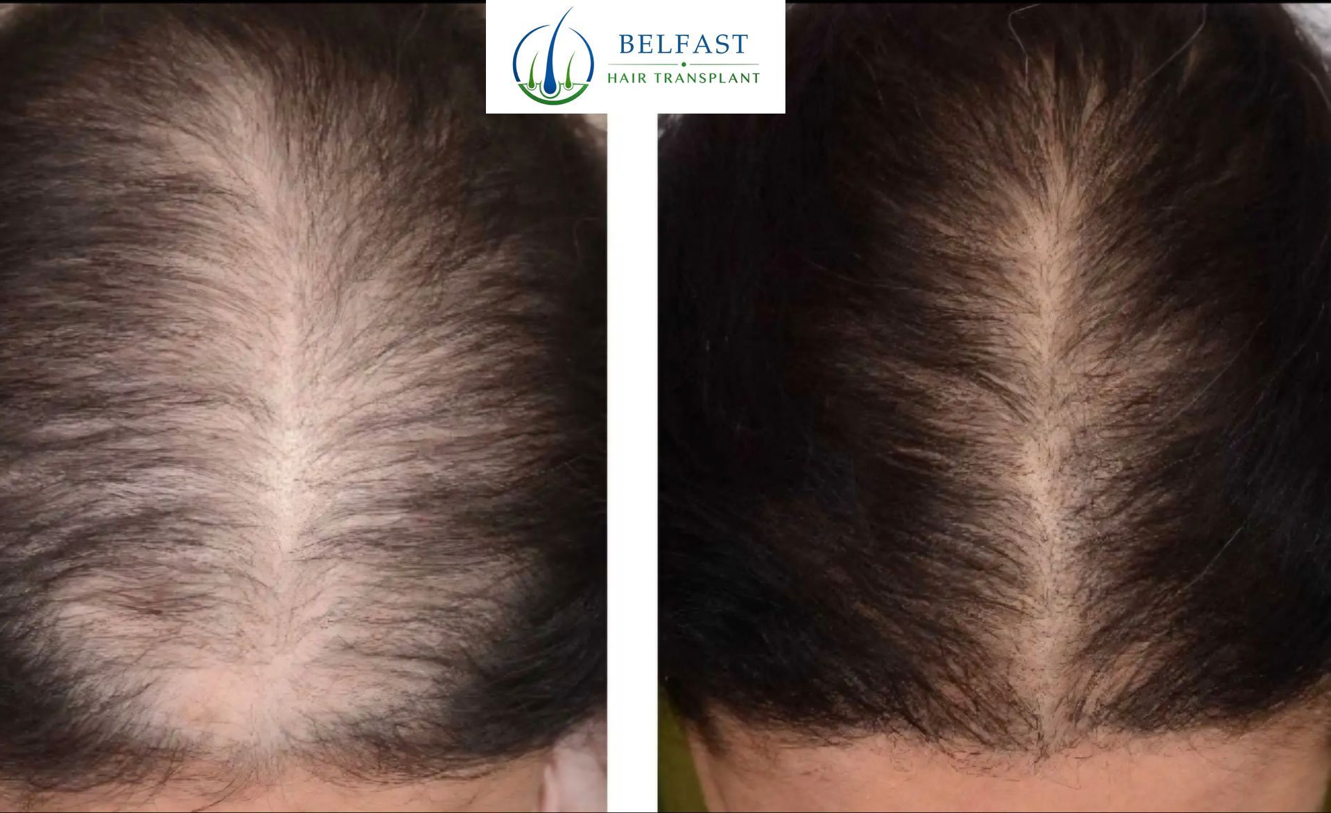 Results after six PRP sessions at nine months
