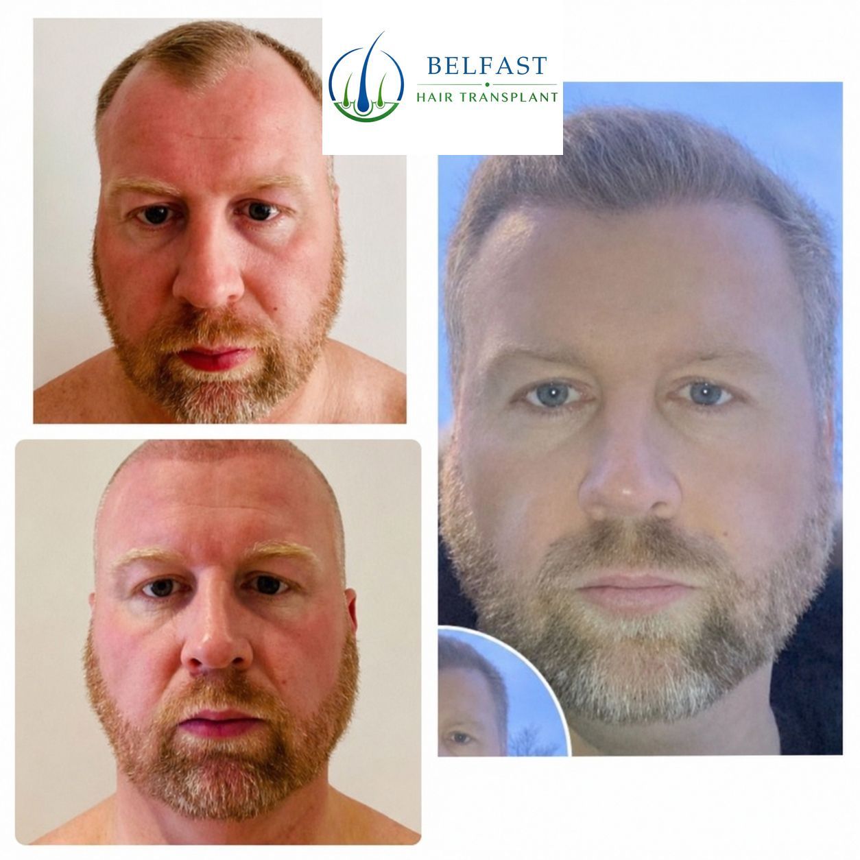 Hair transplant patient result
