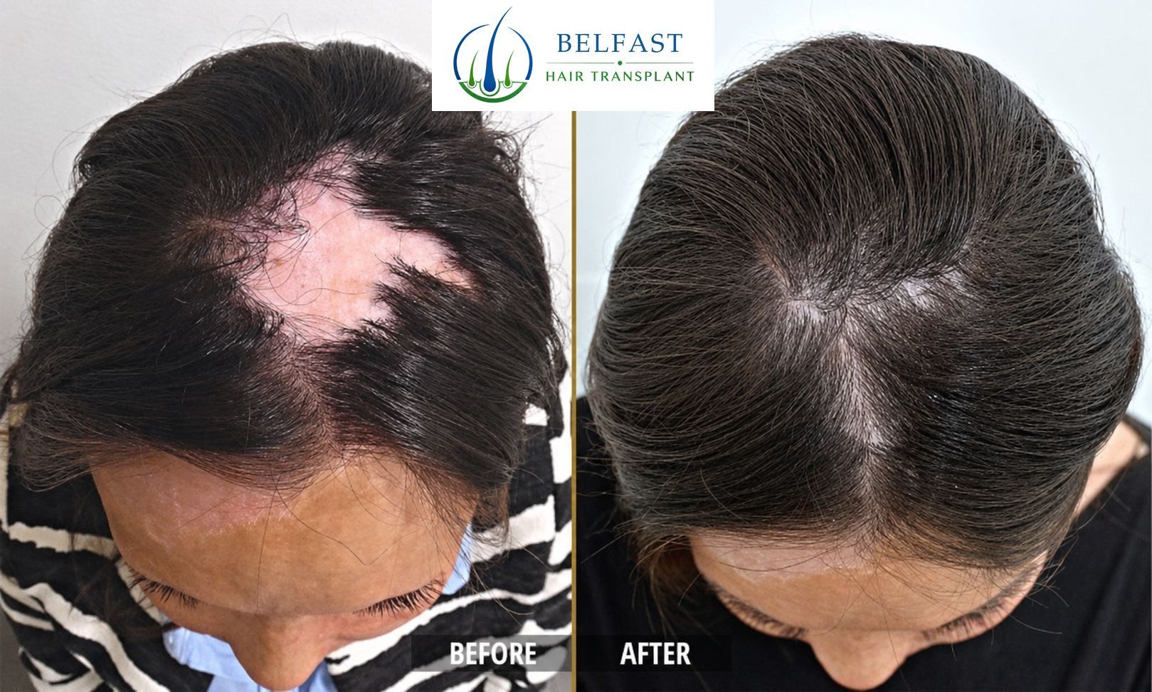 Helen's DHI mid-scalp transplant result