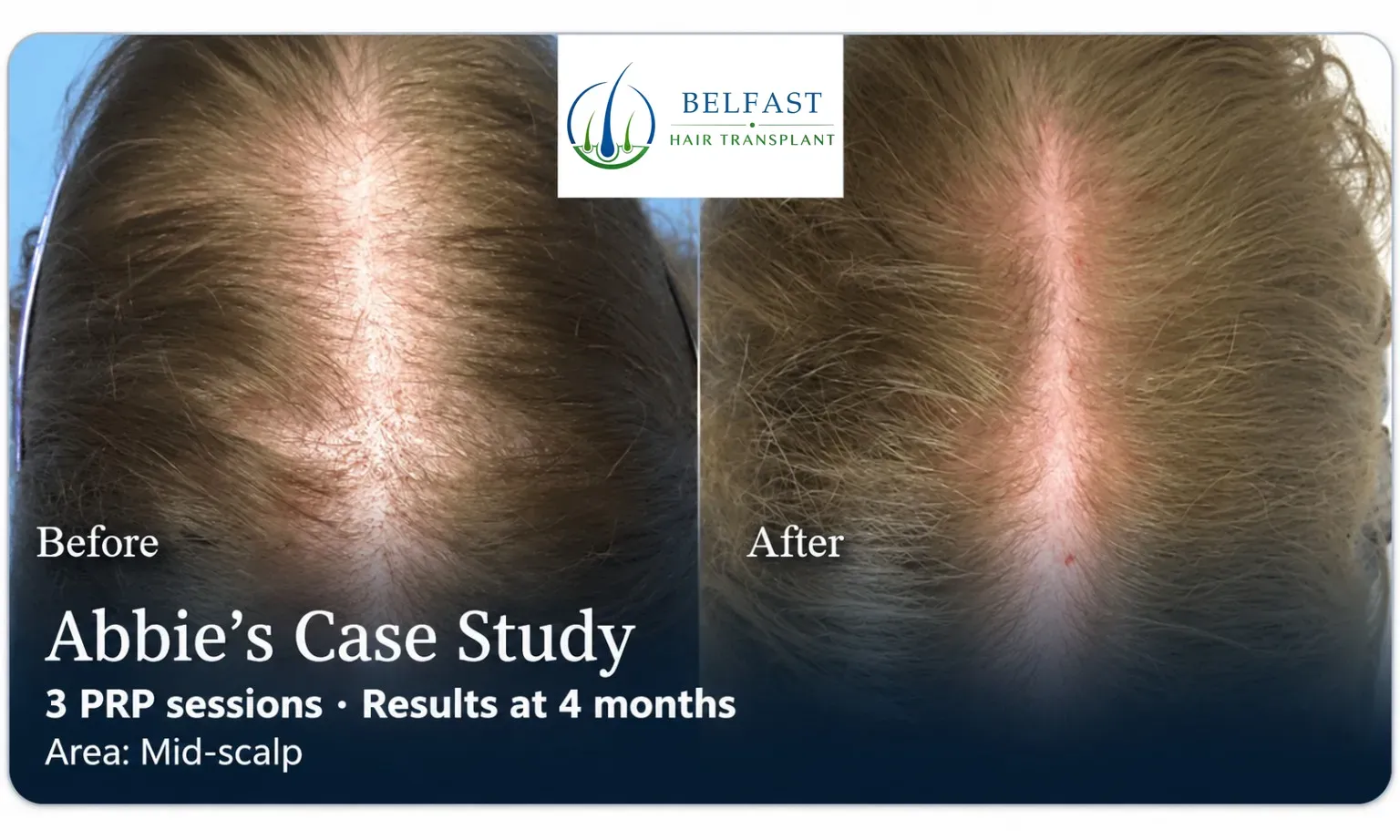 Abbie: PRP, Mid-scalp, 3 prp sessions, results at 4 months