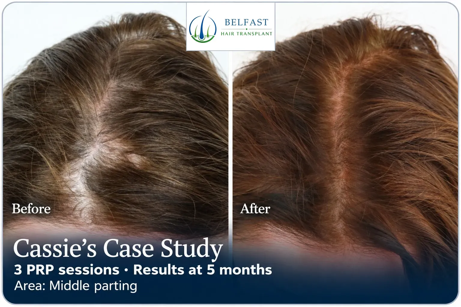 Cassie: PRP, Middle parting, 3 prp sessions, results at 5 months
