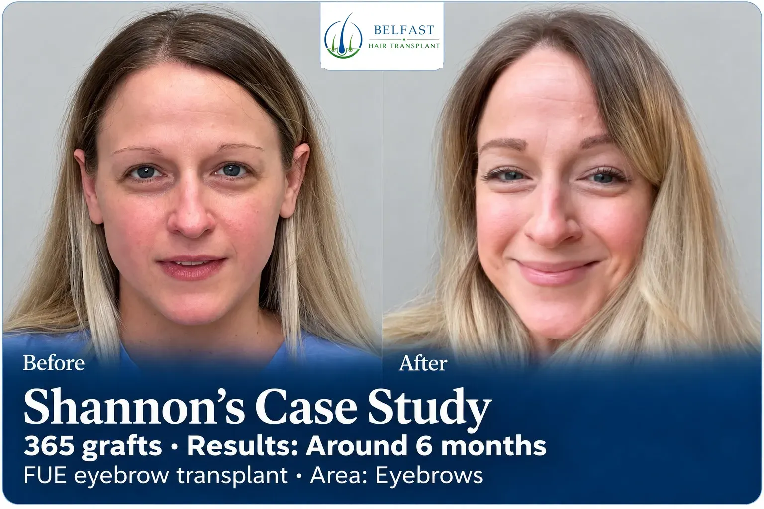 Shannon: FUE eyebrow transplant, Eyebrows, 365 grafts, results at 6 months
