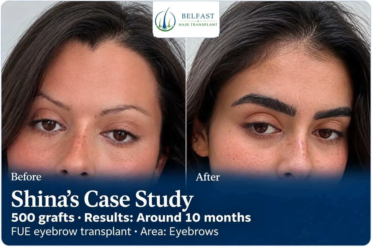 Shina: FUE eyebrow transplant, Eyebrows, 500 grafts, results at 10 months