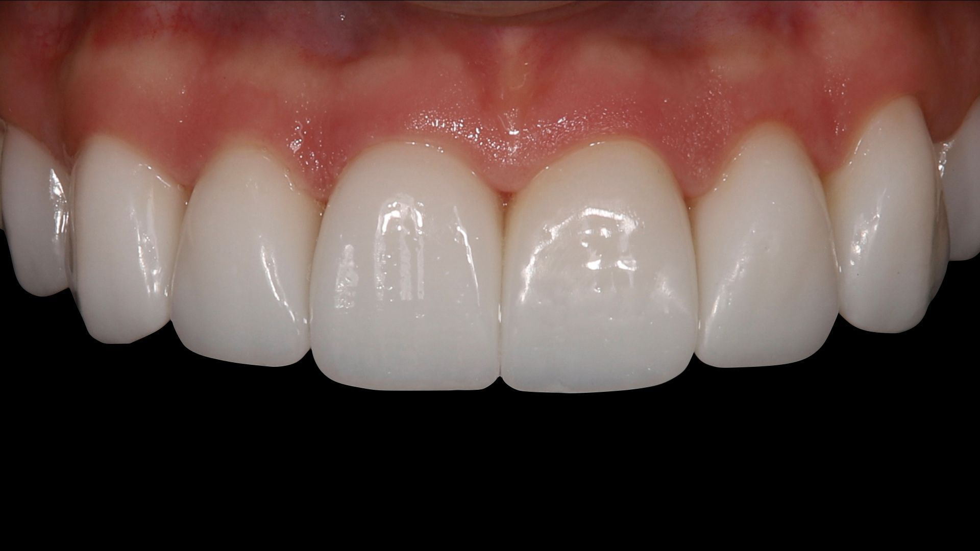 A close up of a person 's teeth on a black background.