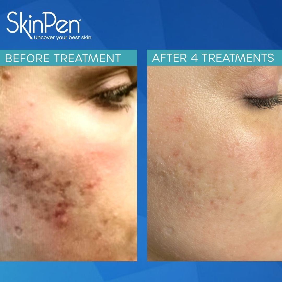 microneedling