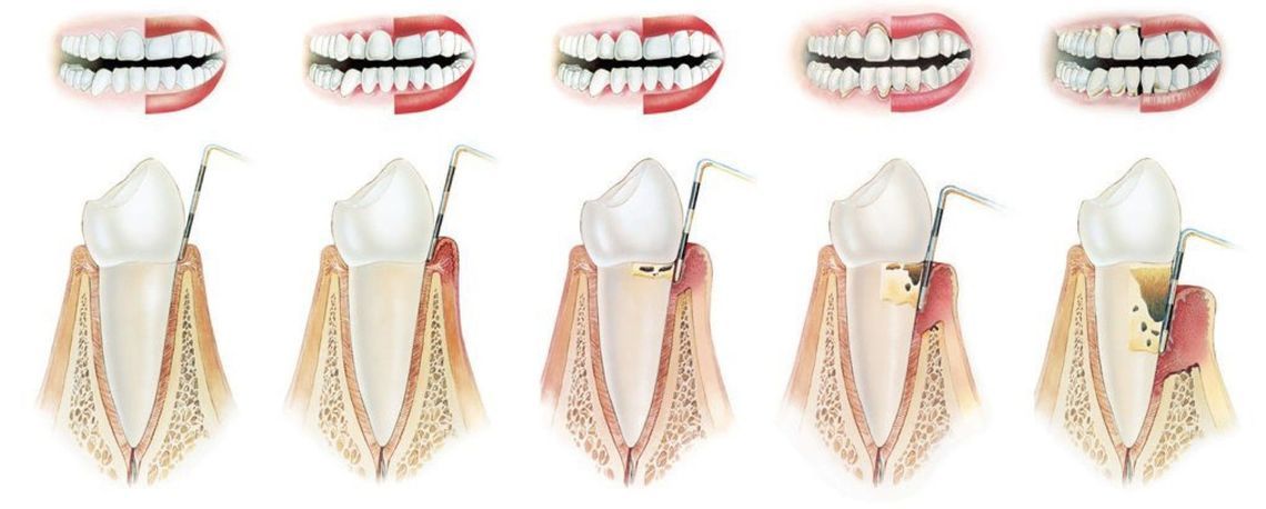 Periodontologinis gydymas (periodontologai) Periodontologinis gydymas (periodontologai)