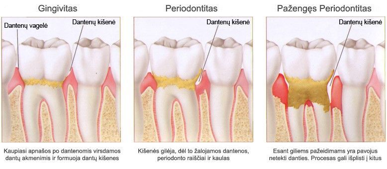 Profesionali burnos higiena ir profilaktika Profesionali burnos higiena ir profilaktika