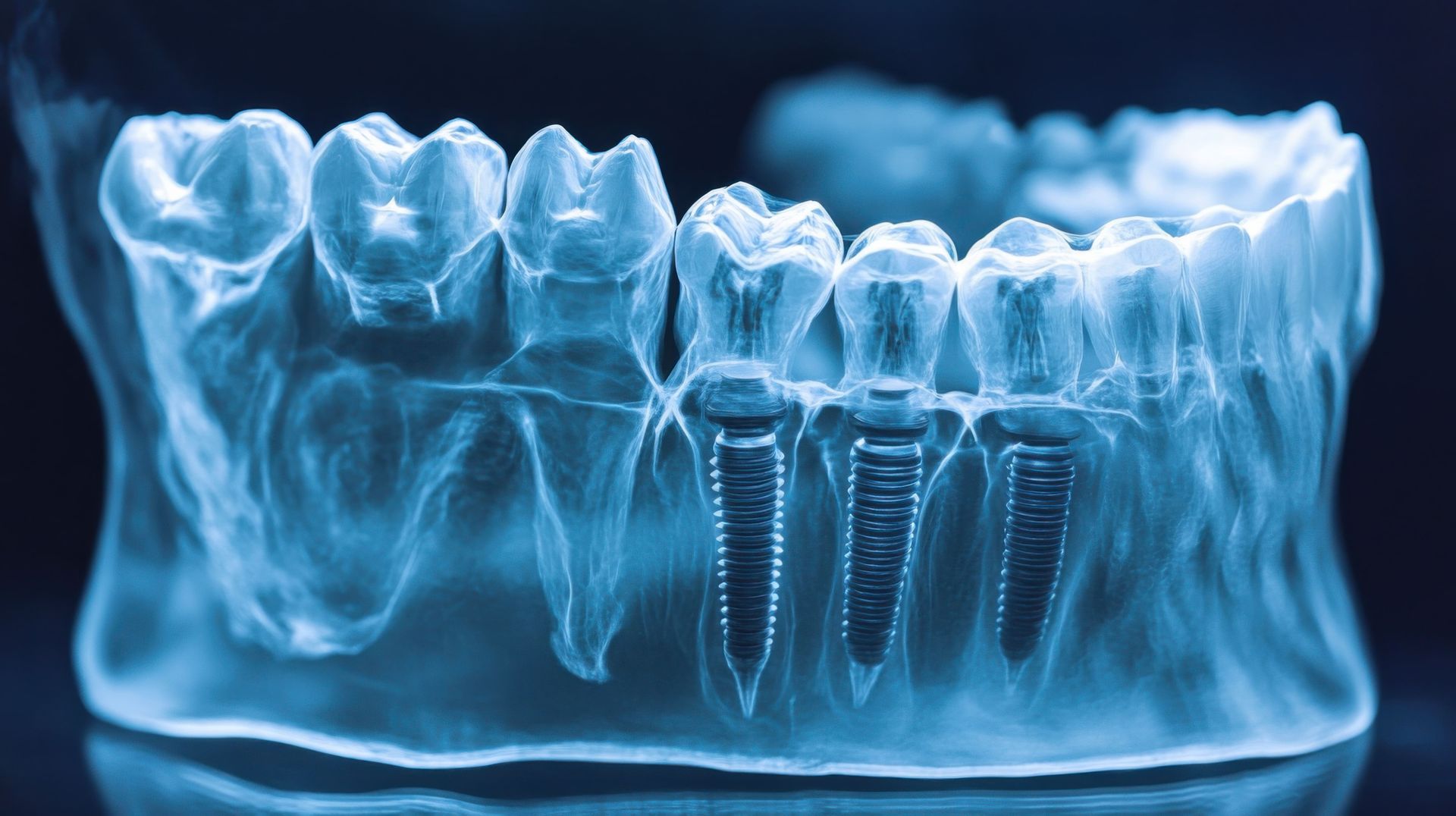 Radiografia de um maxilar mostrando dentes e implantes dentários em azul e cinza.