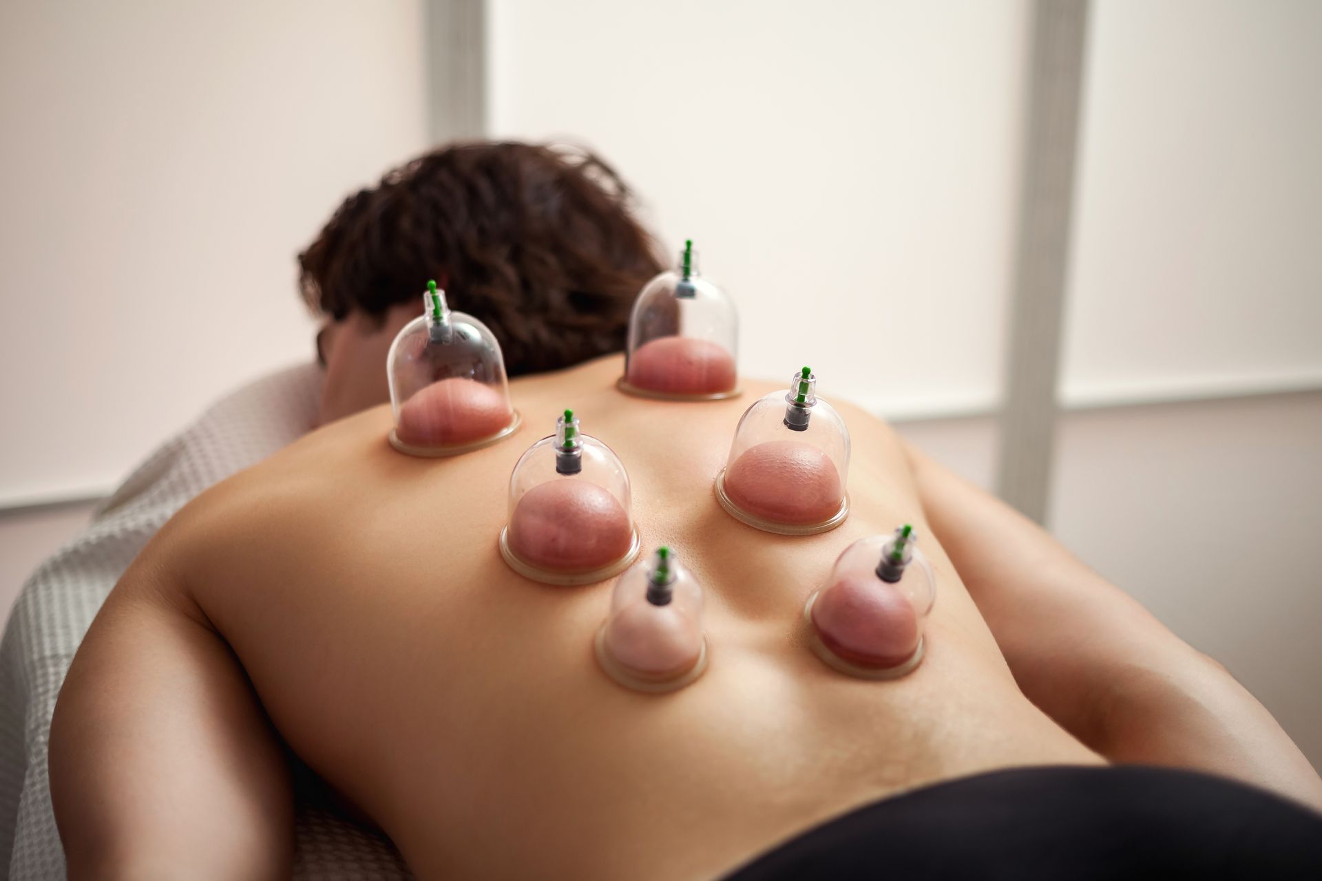 Person receiving cupping therapy on their back with red marks from cups.