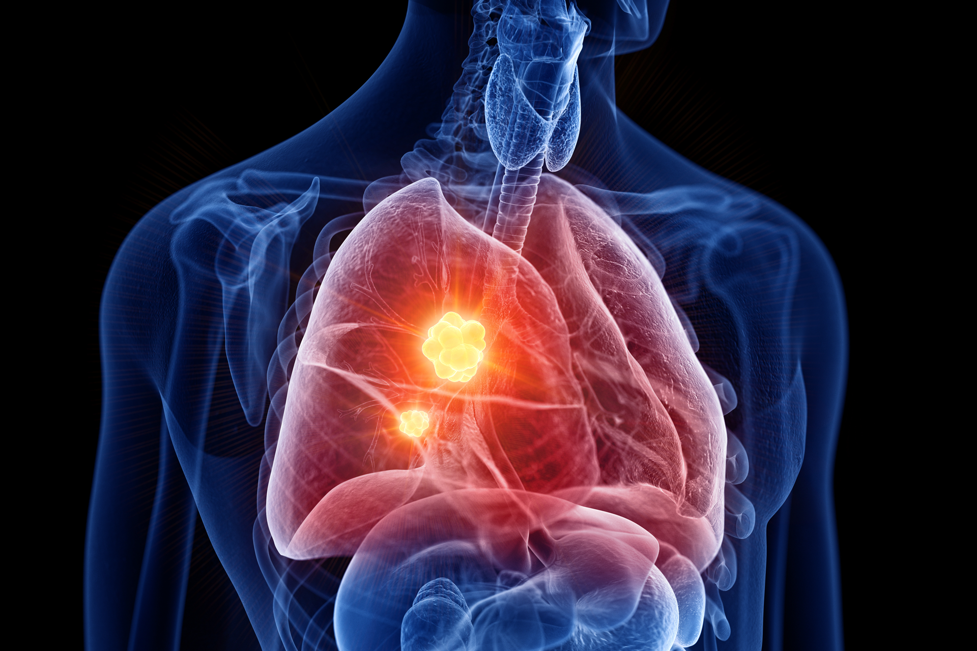 cirurgia de câncer de pulmão