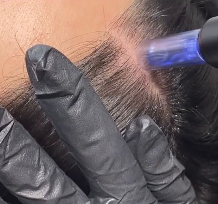 meso hairtreatment dames, mesotherapie haar vrouw, haargroei stimuleren vrouw, haaruitval vrouw, dunner wordend haar vrouw, haarbehandeling dames, persoonlijke aandacht haar, Nijmegen , SEV Aesthetic, SEV, kapsalon, schoonheidssalon, schoonheidsspecialiste