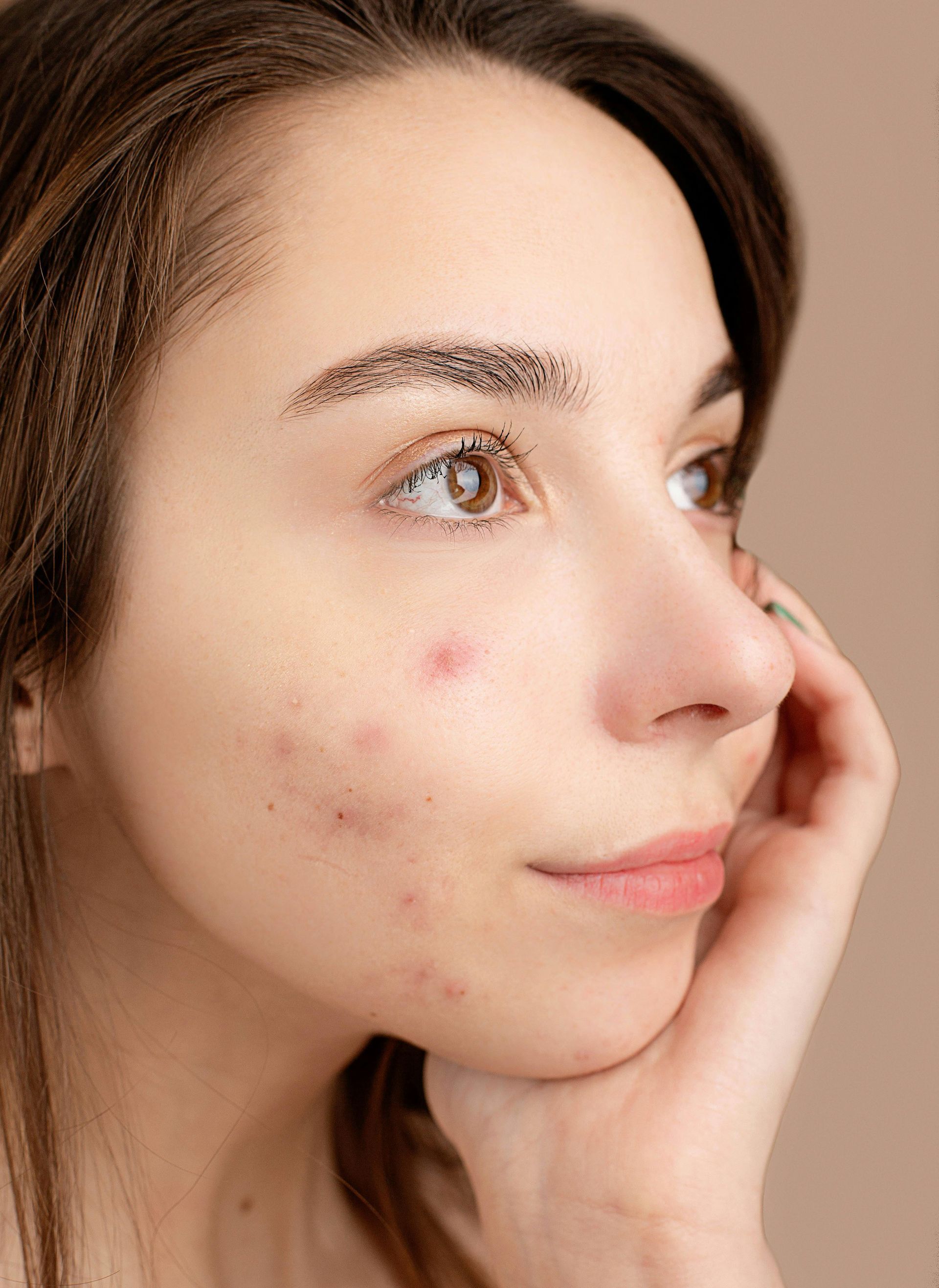Vrouw met acne voor behandeling bij SEV Nijmegen