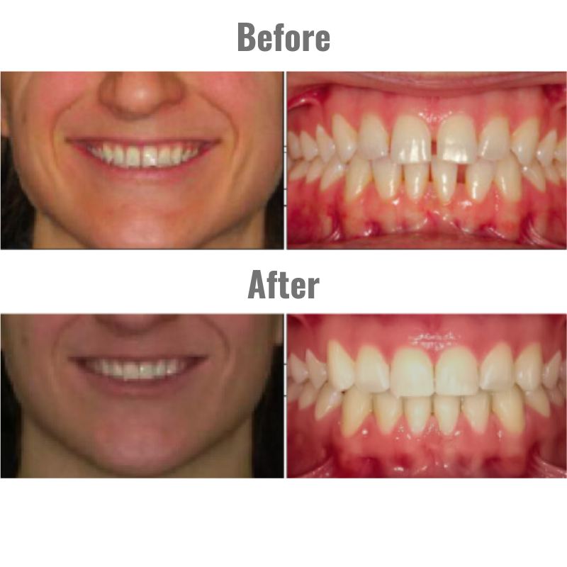 A before and after picture of a woman 's teeth.