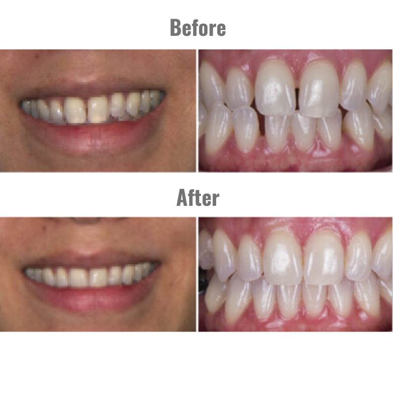 A before and after photo of a woman 's teeth, demonstrating how clear aligners help