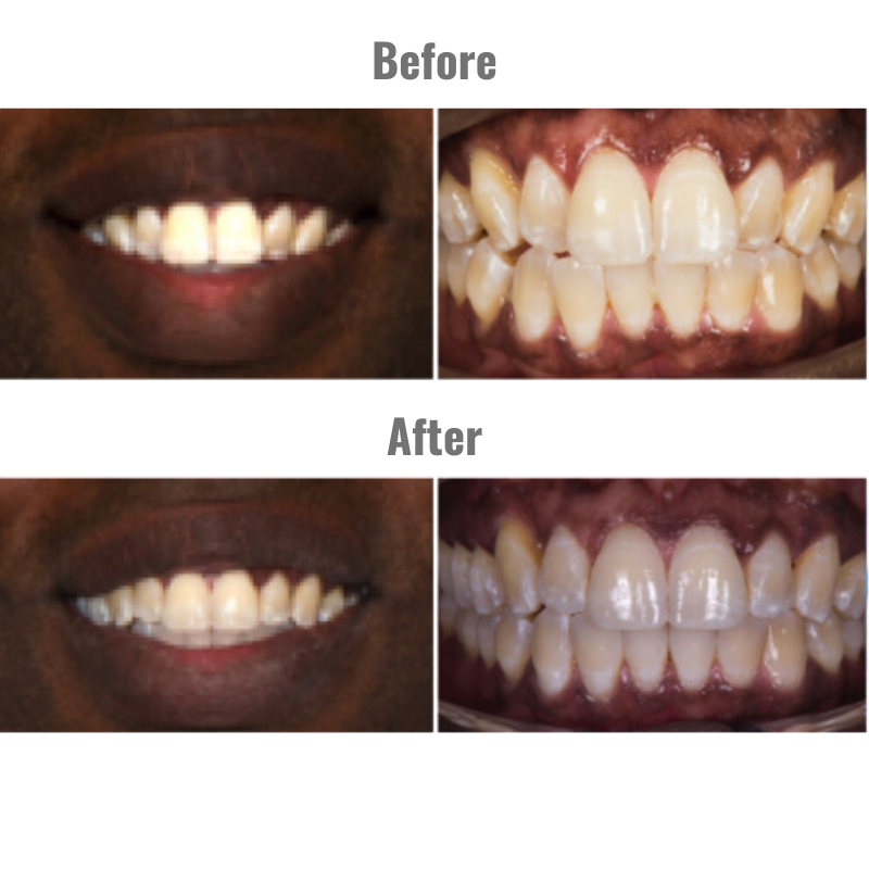 A before and after picture of a person 's teeth, demonstrating how clear aligners help