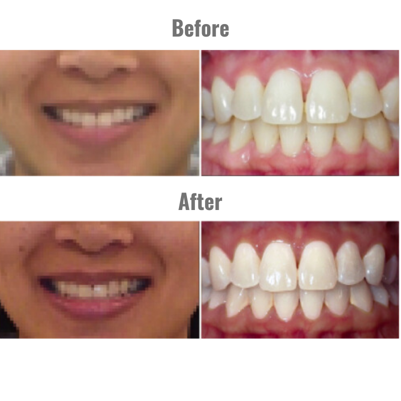 A before and after picture of a woman 's teeth, demonstrating how clear aligners help