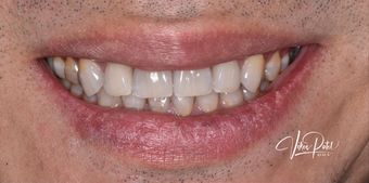 After dental procedure