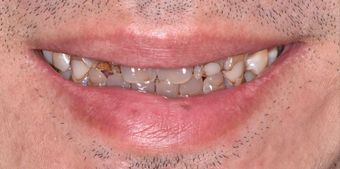 Before dental procedure