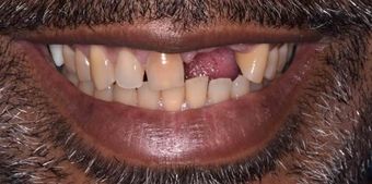 Before dental procedure