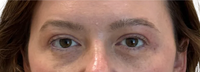 Close-up of a person’s eyes and upper face, looking at the camera with a neutral expression.
