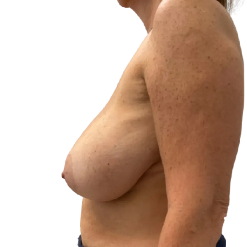 Side view of an unclothed torso against a plain white background