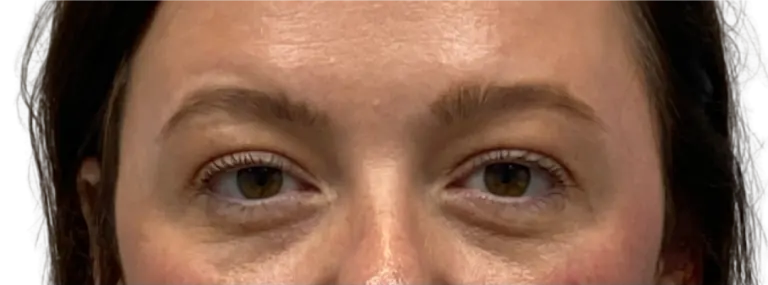 Close-up of a person’s eyes and upper face, with light skin and a neutral expression