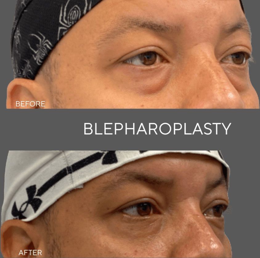 Before-and-after close-up of eyelid surgery results, labeled blepharoplasty.