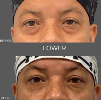 Before-and-after close-up of eyes, labeled “LOWER,” showing reduced under-eye puffiness.