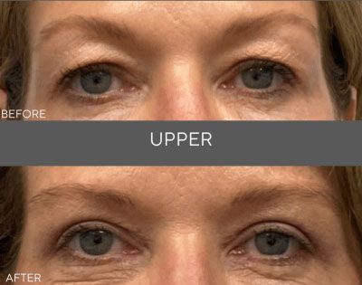Before-and-after close-up of eyes with “UPPER” text between the two images.