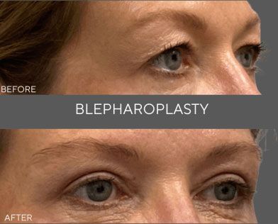 Before-and-after close-up of eyelid surgery, labeled “BLEPHAROPLASTY.”