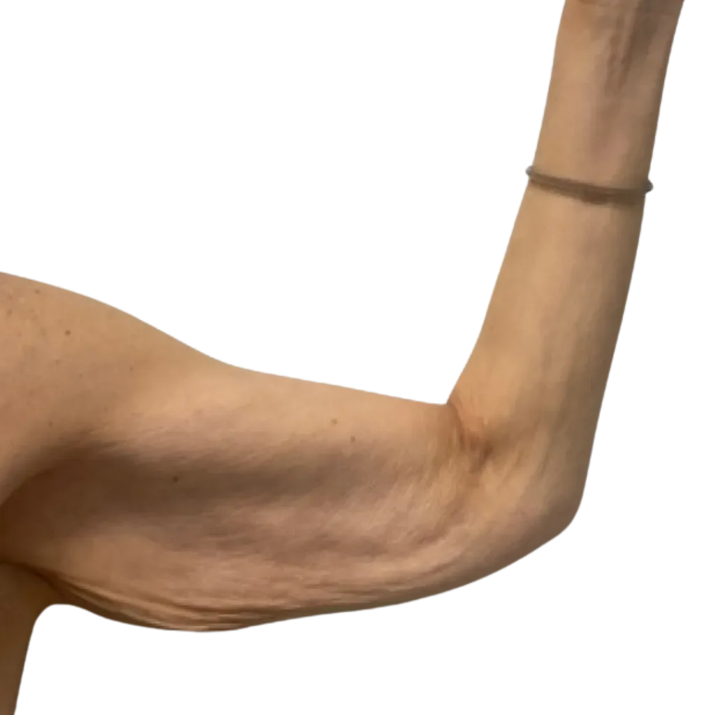 Bent arm with visible loose skin on the upper arm, against a plain white background