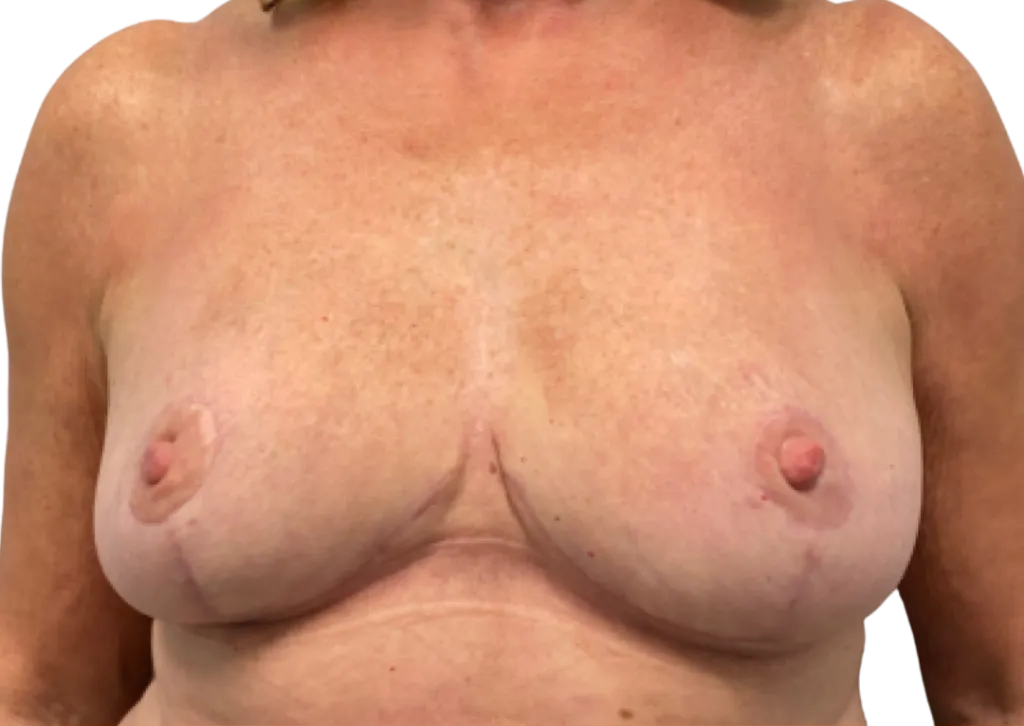 Close-up of a bare chest with breasts, cropped at the shoulders and torso.