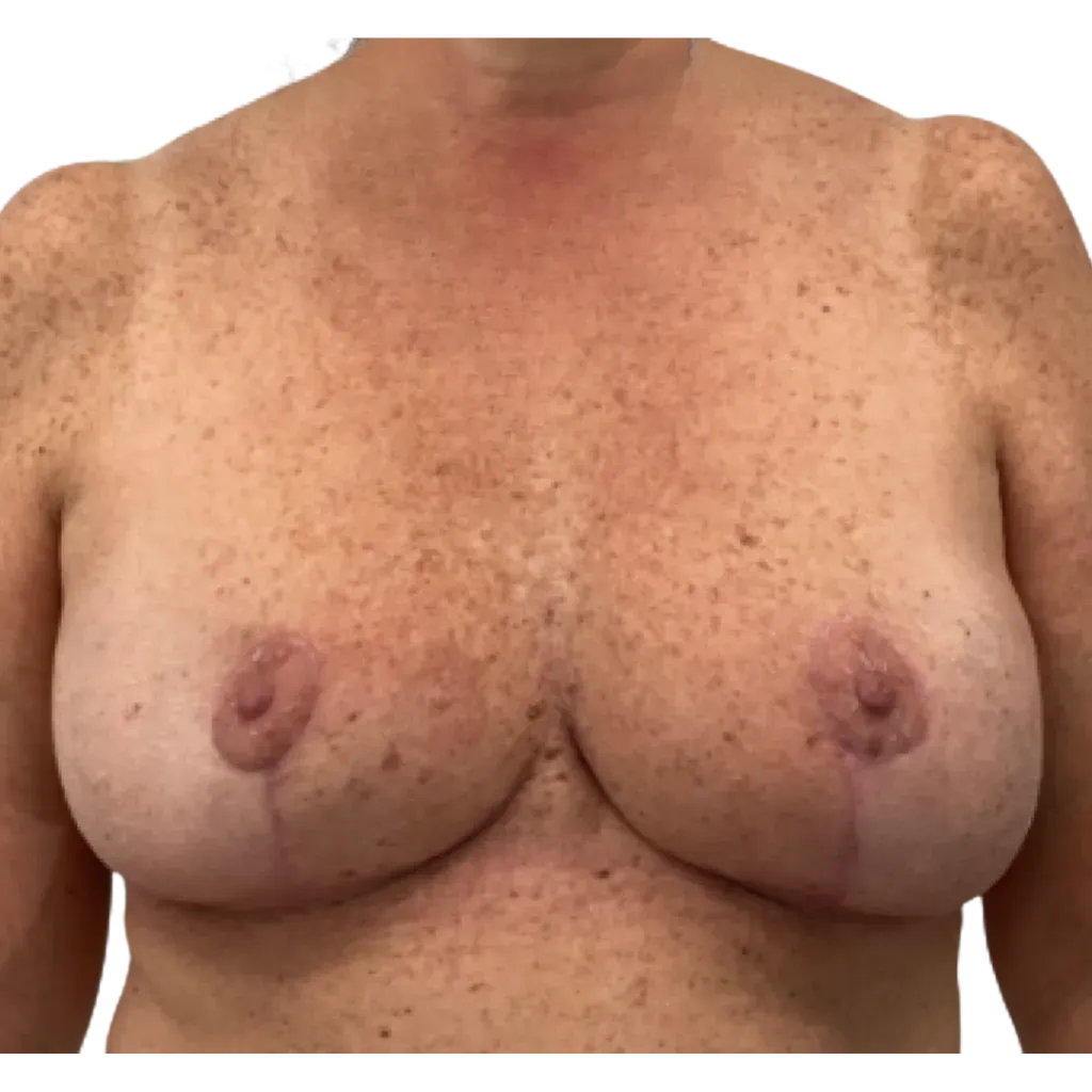 Close-up of an adult torso showing bare chest and shoulders against a plain background